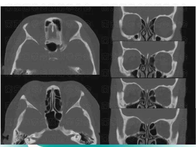 【病例】眼眶腺样囊性癌1例CT及MR影像表现