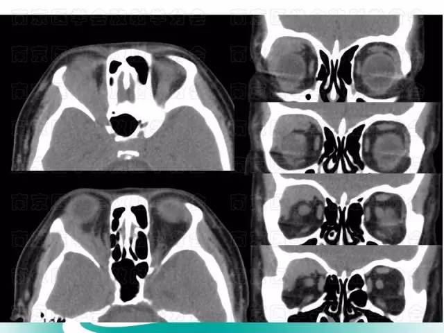 【病例】眼眶腺样囊性癌1例CT及MR影像表现