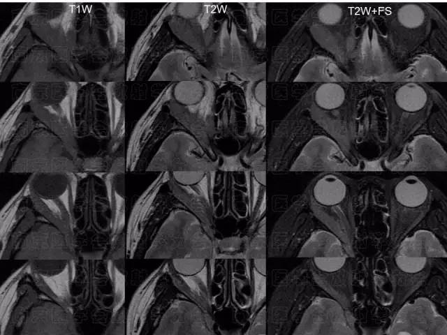 【病例】眼眶腺样囊性癌1例CT及MR影像表现