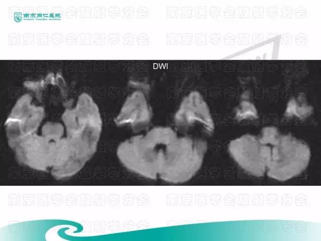 【病例】眼眶腺样囊性癌1例CT及MR影像表现