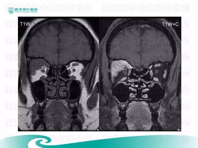 【病例】眼眶腺样囊性癌1例CT及MR影像表现