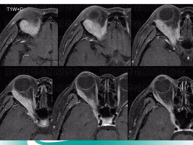 【病例】眼眶腺样囊性癌1例CT及MR影像表现