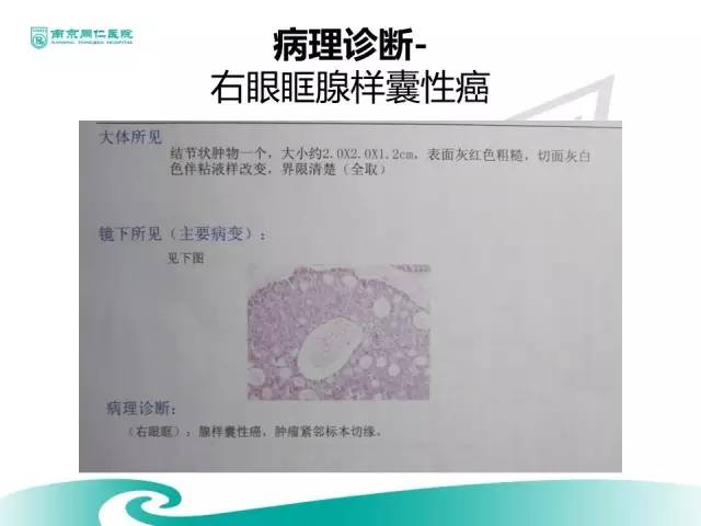 【病例】眼眶腺样囊性癌1例CT及MR影像表现