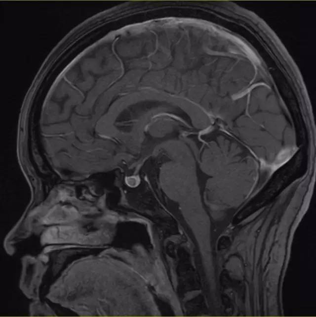 【病例】垂体微腺瘤1例MR影像表现 【病例】垂体微腺瘤1例MR影像表现