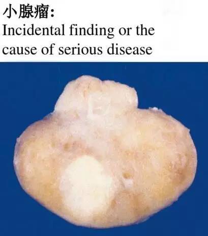 【病例】垂体微腺瘤1例MR影像表现 【病例】垂体微腺瘤1例MR影像表现
