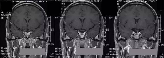 【病例】垂体微腺瘤1例MR影像表现 【病例】垂体微腺瘤1例MR影像表现