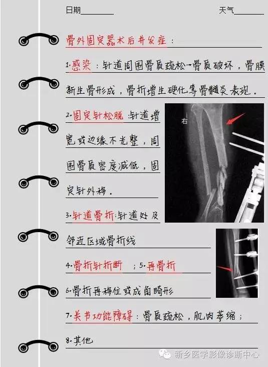 排除这些，就可以大胆的报内外固定术后改变了