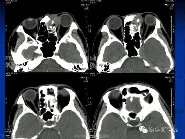 【病例】左鼻腔内翻乳头状瘤1例CT影像表现