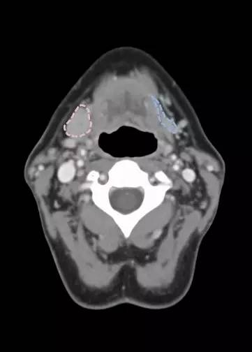 【病例】正常的颌下腺体 可别误认为肿物
