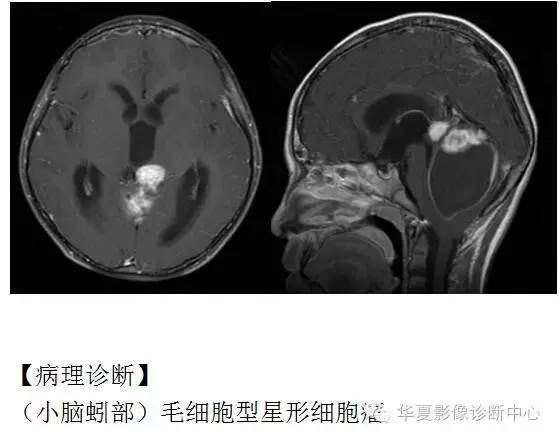 【病例】小脑毛细胞型星形细胞瘤1例MR影像表现