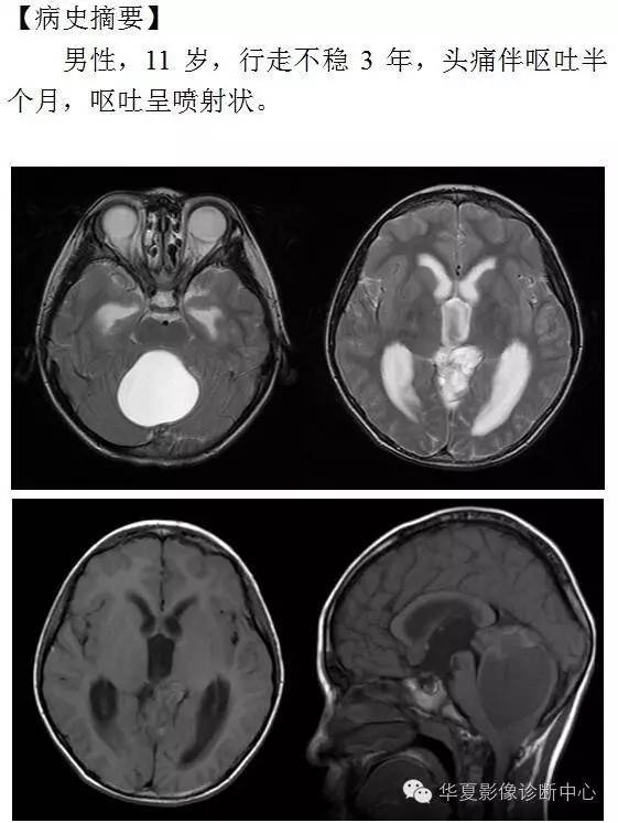 【病例】小脑毛细胞型星形细胞瘤1例MR影像表现