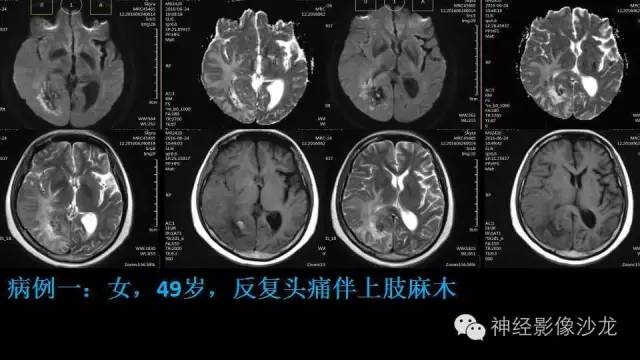 【病例】这四类脑室内肿瘤，您了解么？