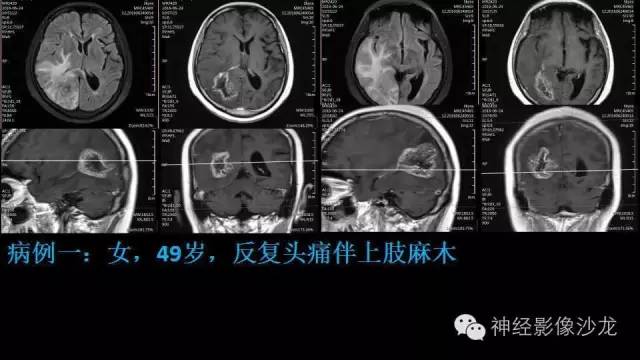 【病例】这四类脑室内肿瘤,您了解么? 【病例】这四类脑室内肿瘤,您了解么?