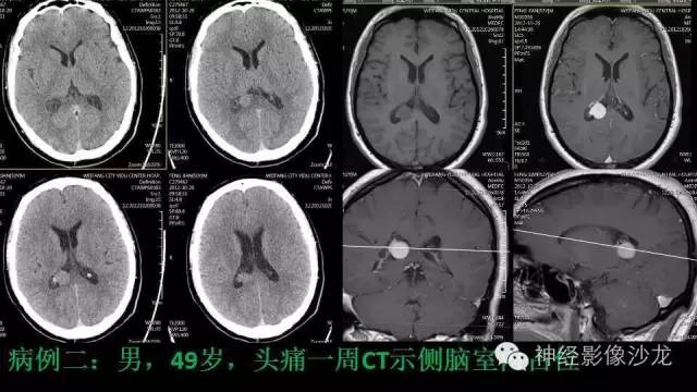 【病例】这四类脑室内肿瘤,您了解么? 【病例】这四类脑室内肿瘤,您了解么?