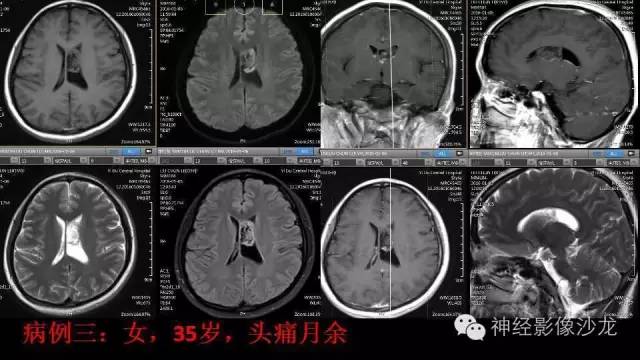 【病例】这四类脑室内肿瘤,您了解么? 【病例】这四类脑室内肿瘤,您了解么?