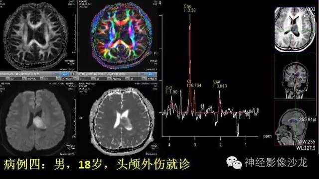 【病例】这四类脑室内肿瘤,您了解么? 【病例】这四类脑室内肿瘤,您了解么?