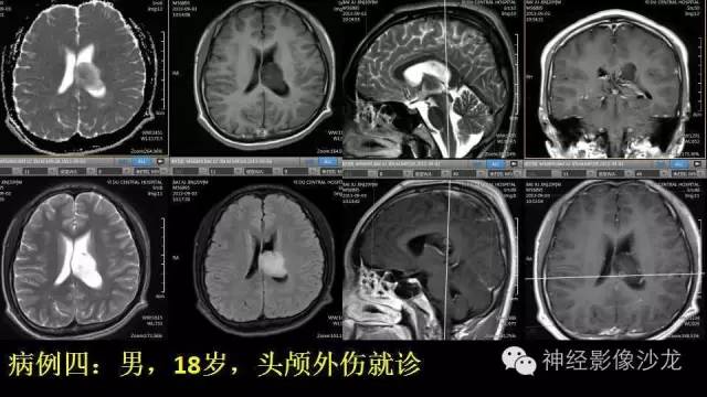【病例】这四类脑室内肿瘤,您了解么? 【病例】这四类脑室内肿瘤,您了解么?