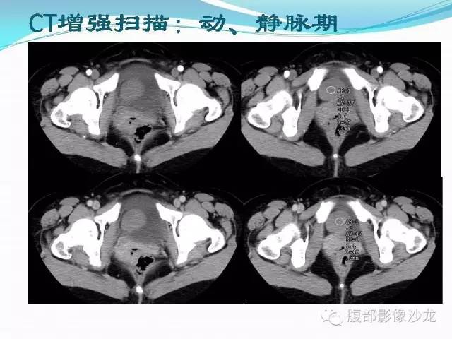 【病例】盆腔神经鞘瘤1例CT及MR 【病例】盆腔神经鞘瘤1例CT及MR