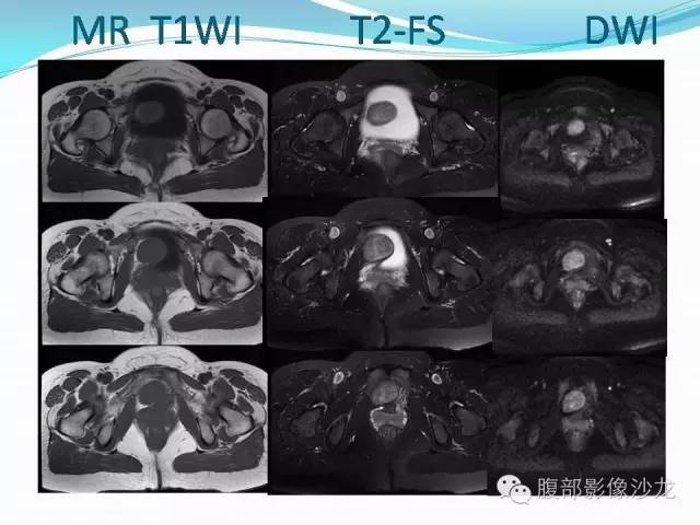 【病例】盆腔神经鞘瘤1例CT及MR 【病例】盆腔神经鞘瘤1例CT及MR