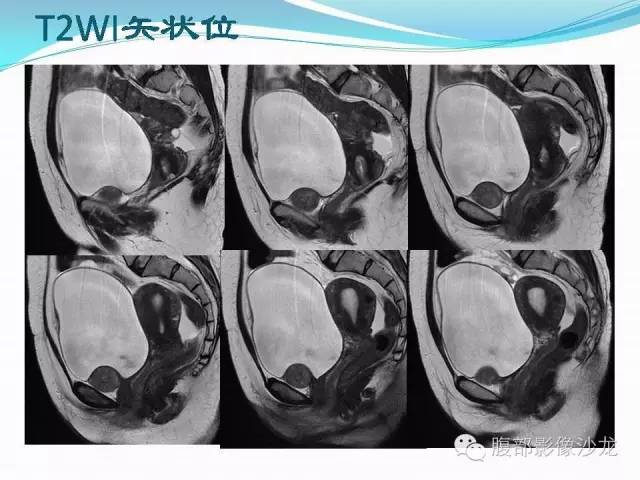 【病例】盆腔神经鞘瘤1例CT及MR 【病例】盆腔神经鞘瘤1例CT及MR
