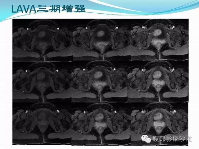 【病例】盆腔神经鞘瘤1例CT及MR 【病例】盆腔神经鞘瘤1例CT及MR