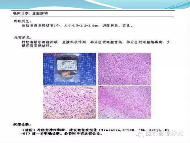 【病例】盆腔神经鞘瘤1例CT及MR 【病例】盆腔神经鞘瘤1例CT及MR