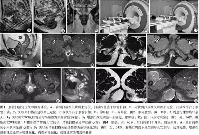 肛管和肛周疾病的MRI诊断