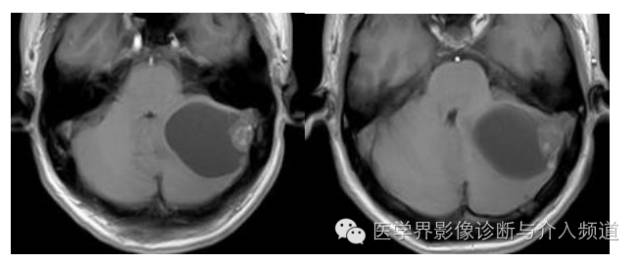 【病例】左侧小脑半球血管母细胞瘤1例MR影像表现 【病例】左侧小脑半球血管母细胞瘤1例MR影像表现