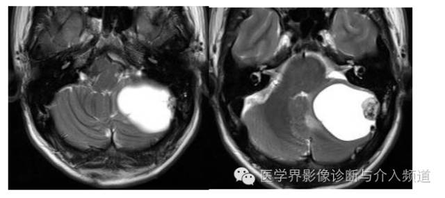 【病例】左侧小脑半球血管母细胞瘤1例MR影像表现