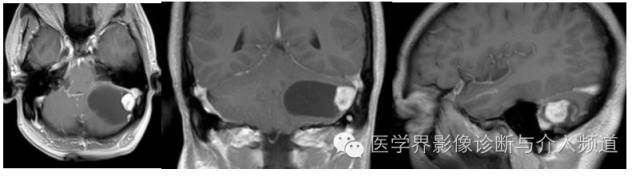 【病例】左侧小脑半球血管母细胞瘤1例MR影像表现 【病例】左侧小脑半球血管母细胞瘤1例MR影像表现