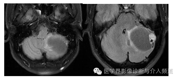 【病例】左侧小脑半球血管母细胞瘤1例MR影像表现 【病例】左侧小脑半球血管母细胞瘤1例MR影像表现