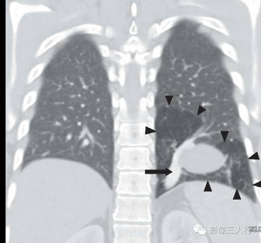 叶内型隔离症
