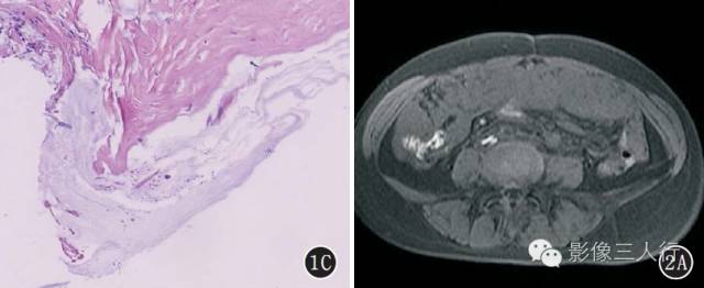 腹膜假性黏液瘤的CT、MRI表现