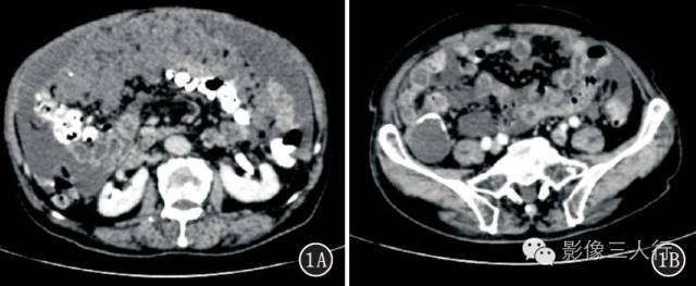 腹膜假性黏液瘤的CT、MRI表现
