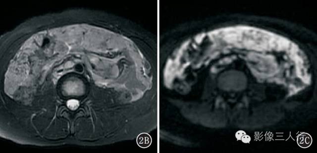 腹膜假性黏液瘤的CT、MRI表现