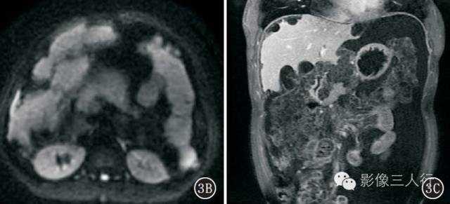 腹膜假性黏液瘤的CT、MRI表现