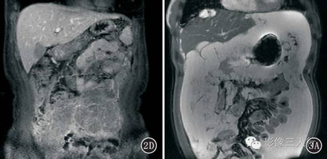 腹膜假性黏液瘤的CT、MRI表现