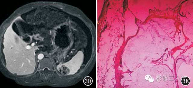 腹膜假性黏液瘤的CT、MRI表现