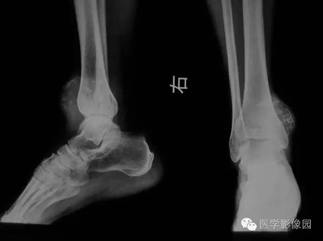【病例】右胫骨下段软骨肉瘤1例X线CT影像表现