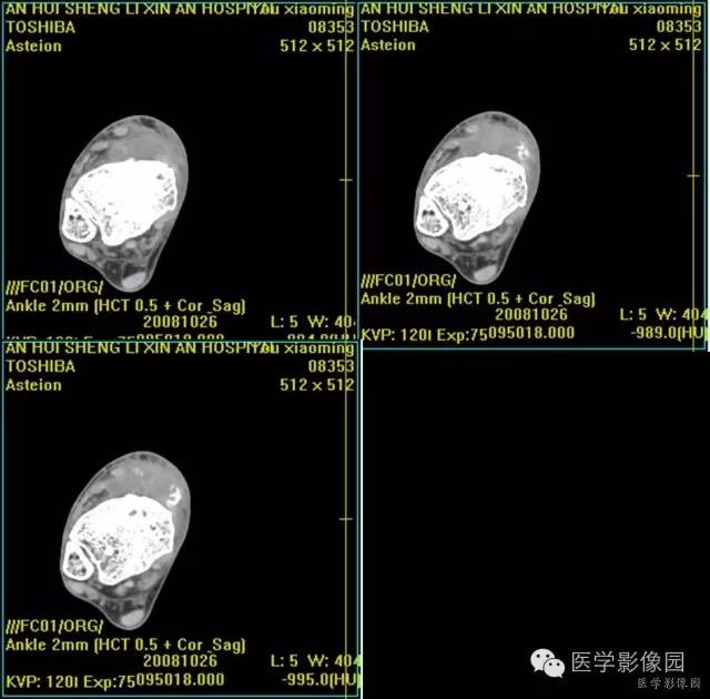 【病例】右胫骨下段软骨肉瘤1例X线CT影像表现 【病例】右胫骨下段软骨肉瘤1例X线CT影像表现