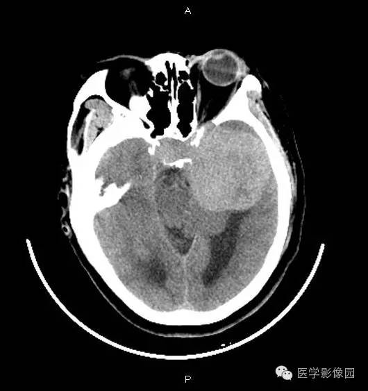【病例】鞍旁海绵状血管瘤1例CT及MR影像表现