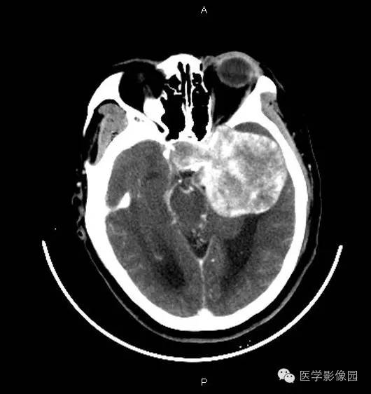 【病例】鞍旁海绵状血管瘤1例CT及MR影像表现 【病例】鞍旁海绵状血管瘤1例CT及MR影像表现