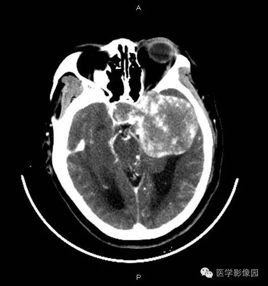 【病例】鞍旁海绵状血管瘤1例CT及MR影像表现 【病例】鞍旁海绵状血管瘤1例CT及MR影像表现
