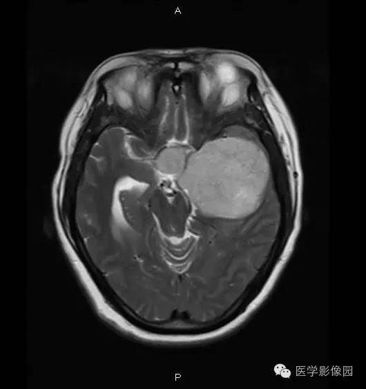【病例】鞍旁海绵状血管瘤1例CT及MR影像表现 【病例】鞍旁海绵状血管瘤1例CT及MR影像表现