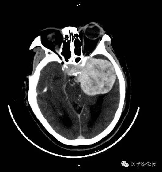 【病例】鞍旁海绵状血管瘤1例CT及MR影像表现 【病例】鞍旁海绵状血管瘤1例CT及MR影像表现