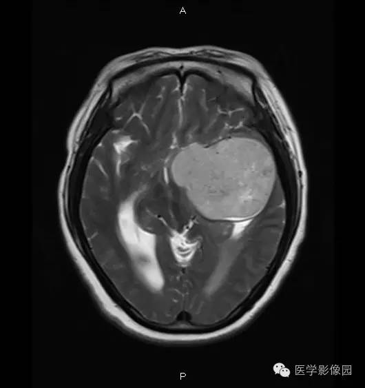 【病例】鞍旁海绵状血管瘤1例CT及MR影像表现 【病例】鞍旁海绵状血管瘤1例CT及MR影像表现