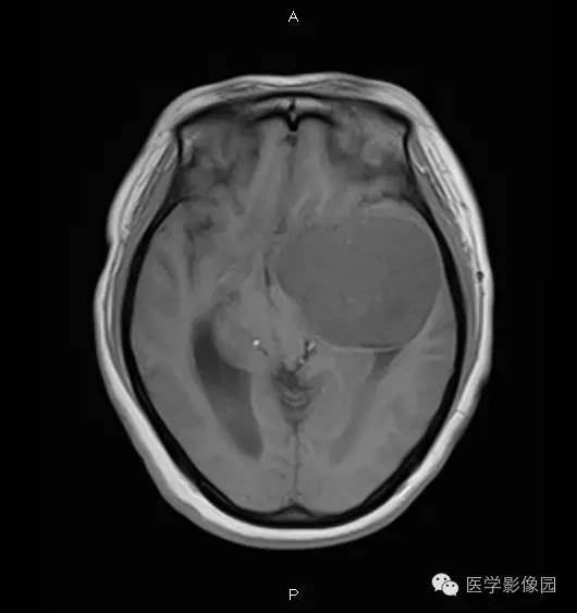 【病例】鞍旁海绵状血管瘤1例CT及MR影像表现 【病例】鞍旁海绵状血管瘤1例CT及MR影像表现