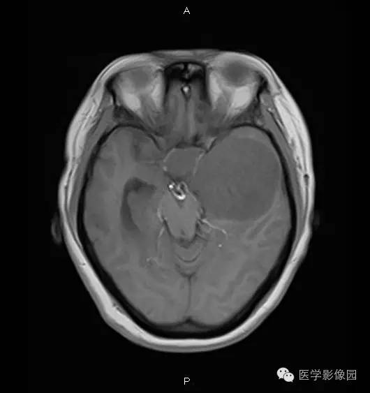 【病例】鞍旁海绵状血管瘤1例CT及MR影像表现 【病例】鞍旁海绵状血管瘤1例CT及MR影像表现