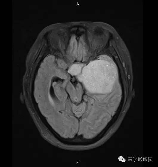【病例】鞍旁海绵状血管瘤1例CT及MR影像表现 【病例】鞍旁海绵状血管瘤1例CT及MR影像表现