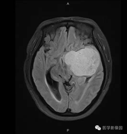 【病例】鞍旁海绵状血管瘤1例CT及MR影像表现 【病例】鞍旁海绵状血管瘤1例CT及MR影像表现